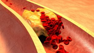 Clogged Artery with platelets and cholesterol plaque, concept for health risk for obesity or dieting and nutrition problems